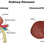 Types of Kidney Disease
